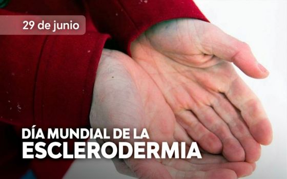 La coloración azulada en los dedos de la mano puede ser síntoma de esclerodermia