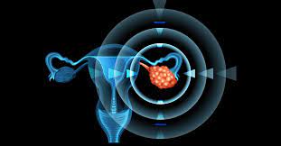 Cáncer de ovario: cuáles son sus causas y cuánto influye la genética